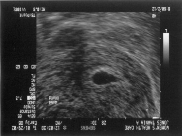  Aislinn's ultrasound at 4 weeks