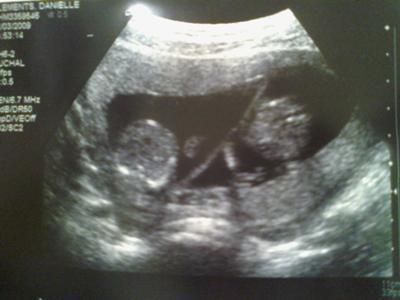  Aislinn's ultrasound at 14 weeks, revealing twins.
