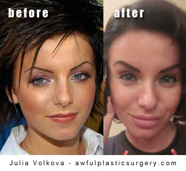 Yulia's plastic surgery