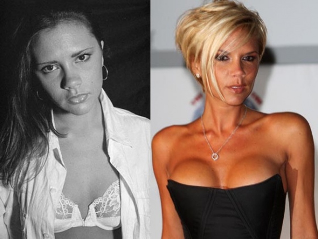 Victoria Beckham Photo: Victoria Beckham before and after plastic surgery.