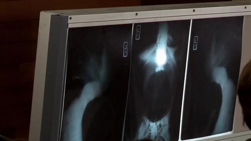  Bella's x-rays
