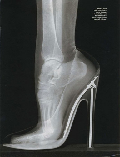  X-Ray of অস্থি while wearing heels