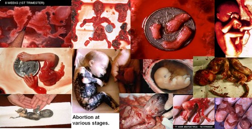  Aborted fetus