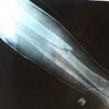 X-ray of my leg! brightspark89 photo